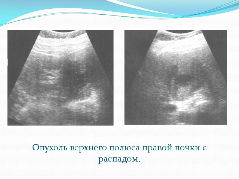 Опухоль верхнего полюса правой почки с распадом.